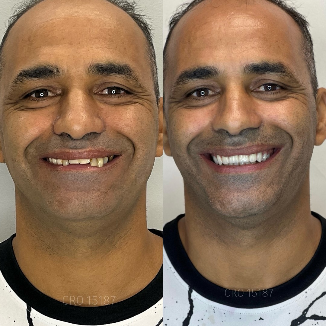 Reabilitação com Implantes